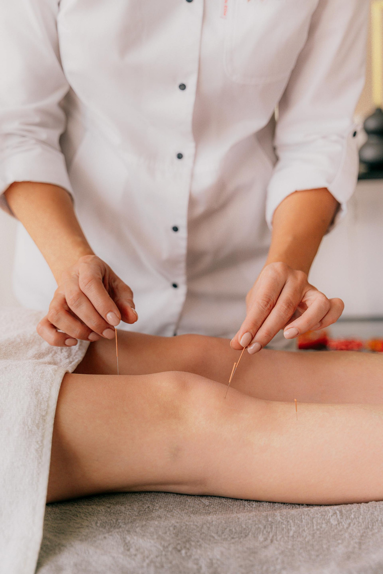 Aplicação de agulhas finas de dry needling na perna